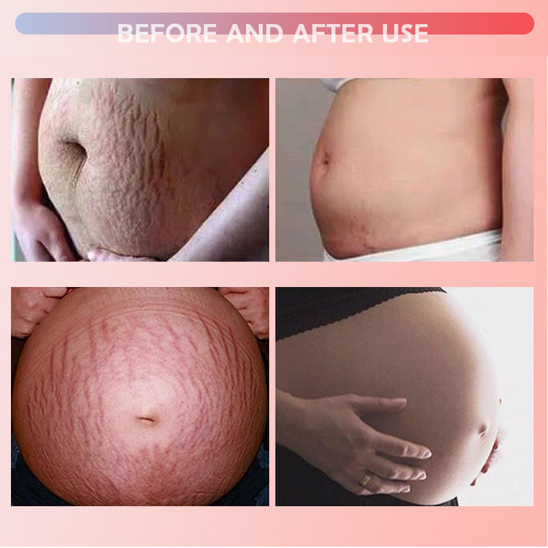 SODSNIE Stretch Mark Vanishing Cream | Skin Smoothing, Discoloration Reducing & Softening Body Cream ? 50g