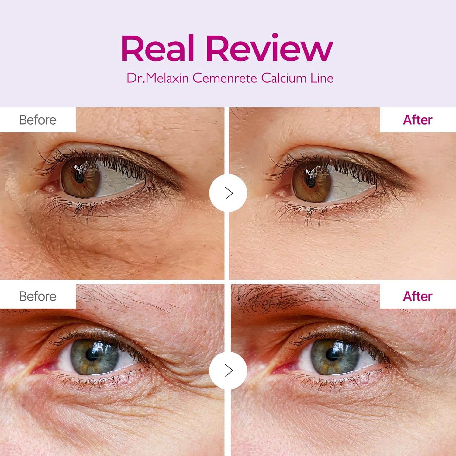 Dr.Melaxin Cemenrete CX Calcium Volume Eye Patch | Rebornic 10,000ppm EX Volume Firming Under Eye Patches for Dark Circles Puffiness & Fine Lines
