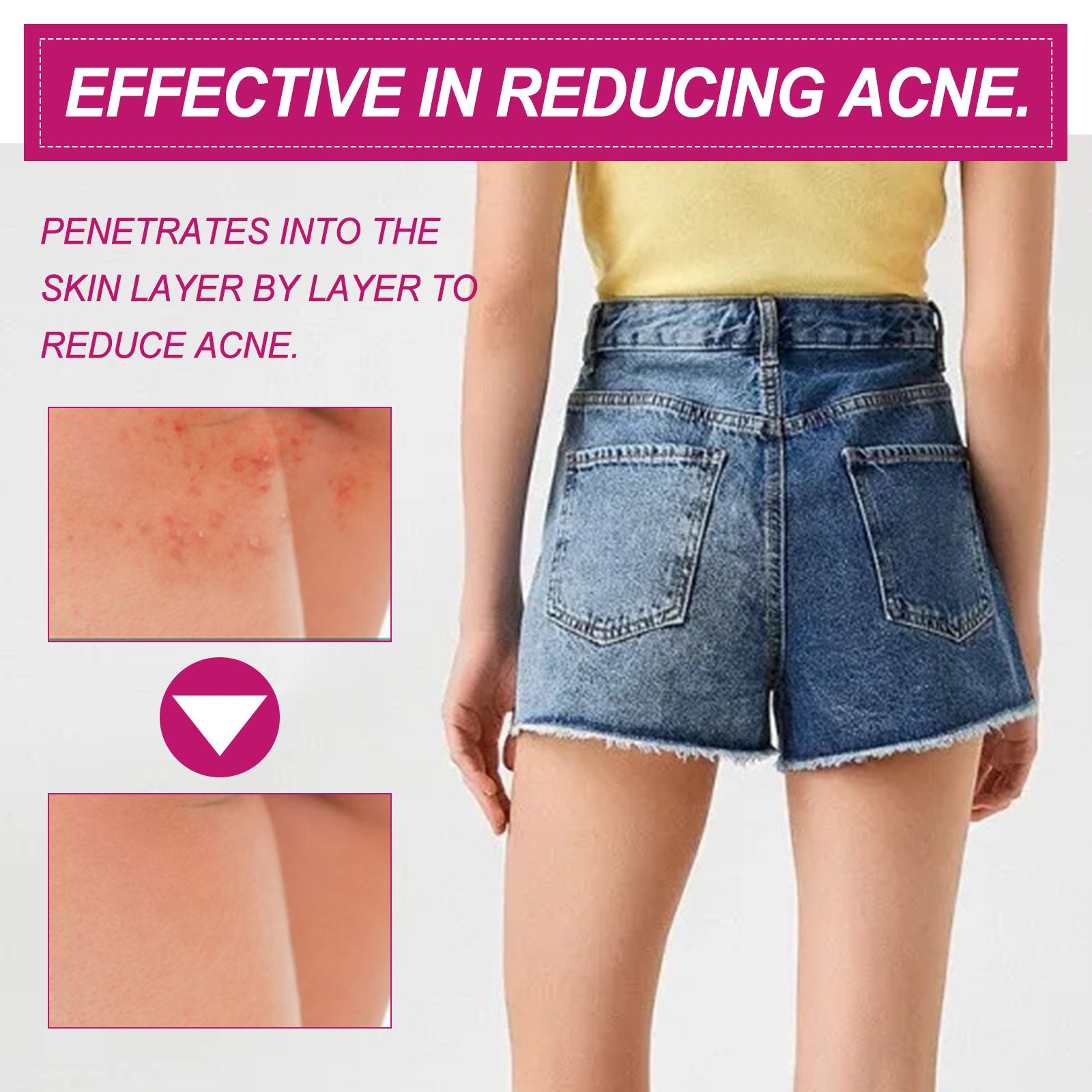 EELHOE Butt & Thigh Acne Cream | Body Blemish Clearing & Skin Smoothing Treatment for Hip & Legs ? 100ml