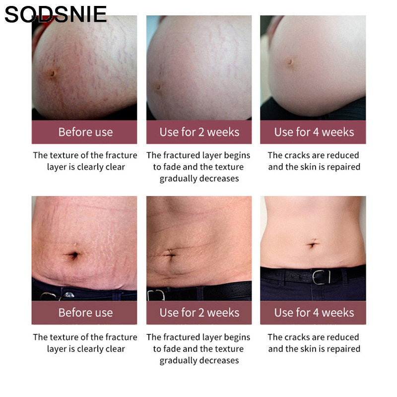 SODSNIE Stretch Mark Vanishing Cream | Skin Smoothing, Discoloration Reducing & Softening Body Cream ? 50g