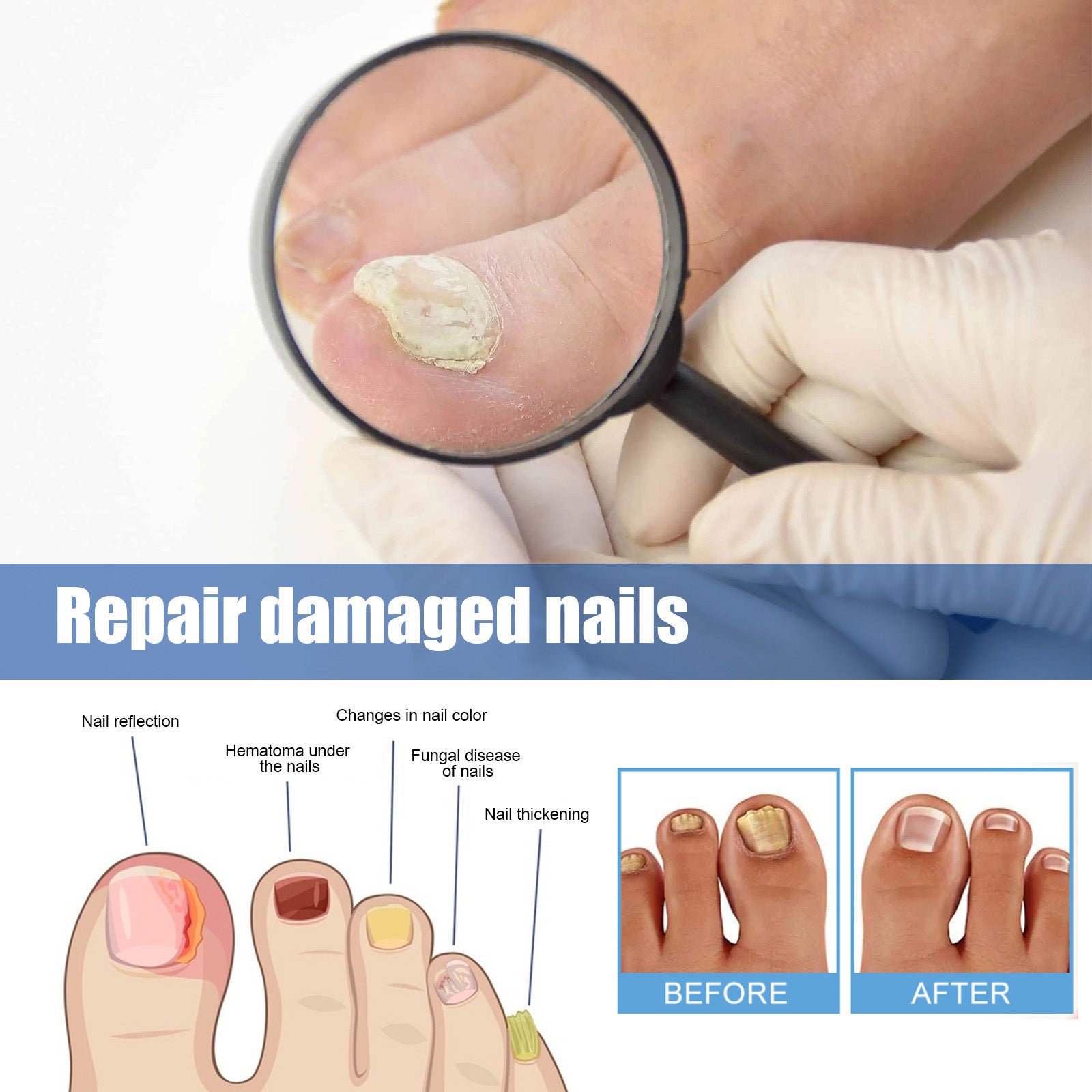 Ximonth Fungal Nail Patches 32-Pack | 8-Hour Overnight Nighttime Nail Treatment | Reduces Discoloration & Thickness Fast