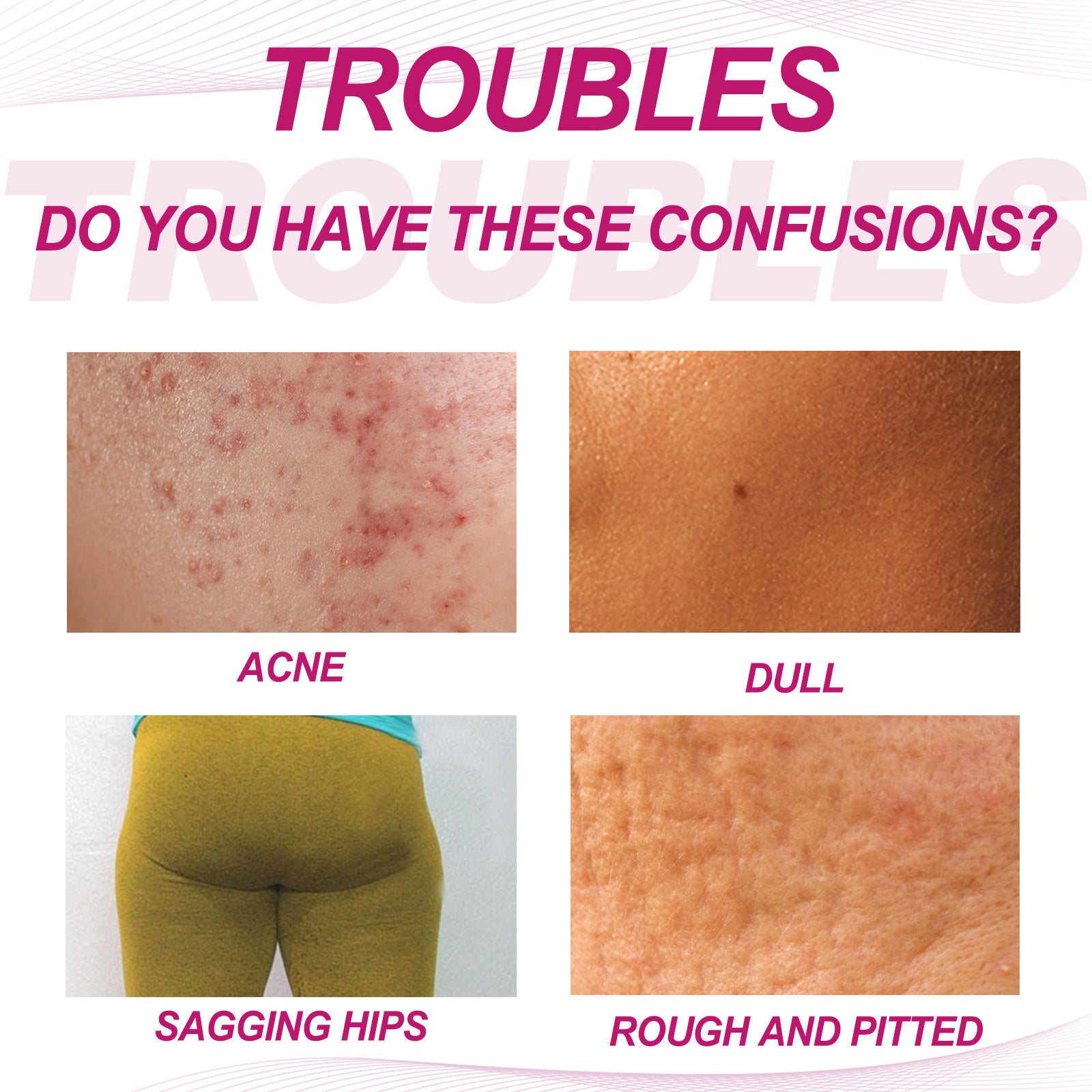 EELHOE Butt & Thigh Acne Cream | Body Blemish Clearing & Skin Smoothing Treatment for Hip & Legs ? 100ml