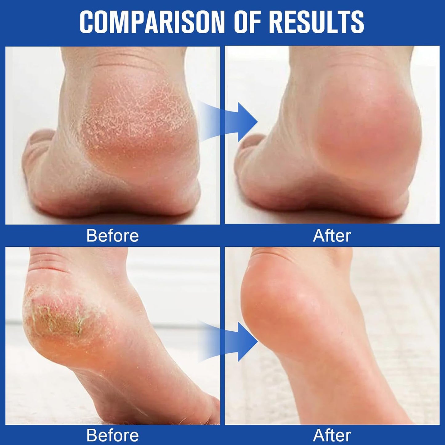 60% Urea Foot Care Stick + 2% Salicylic Acid | Deep Hydration for Dry Cracked Heels & Thickened Skin | Fast Absorbing Non-Greasy Foot Balm | 40g